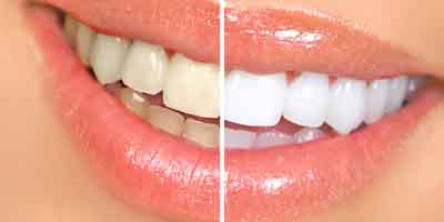 Bleaching Dr. Dreissig Dinkelsbühl