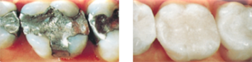 Cerec vorher nachher 180422174007