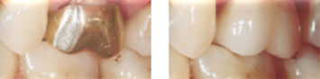 Cerec vorher nachher 180422174019