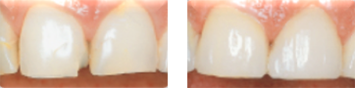Cerec vorher nachher 180422174026