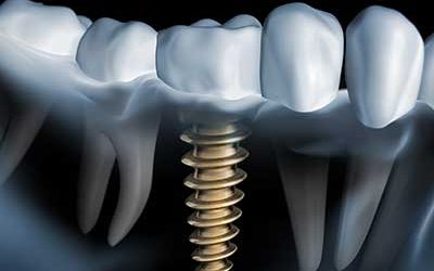 Alles über Implantate 1 Warum wird ein Implantat benötigt?