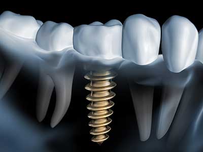 Implantat 180419104434