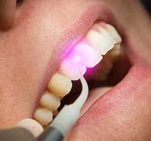 Laserzahnbehandlung 190914144440